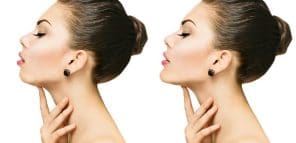 Jawline çene hattı dolgusu